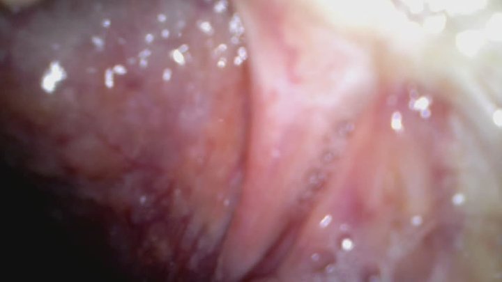 Holy uvula Endoscope camera used