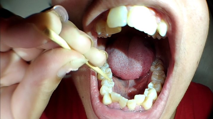 Cleaning plaque off my dirty teeth with a wooden toothpick after 15 days without