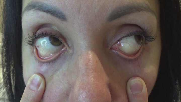 distorted look of the eyes