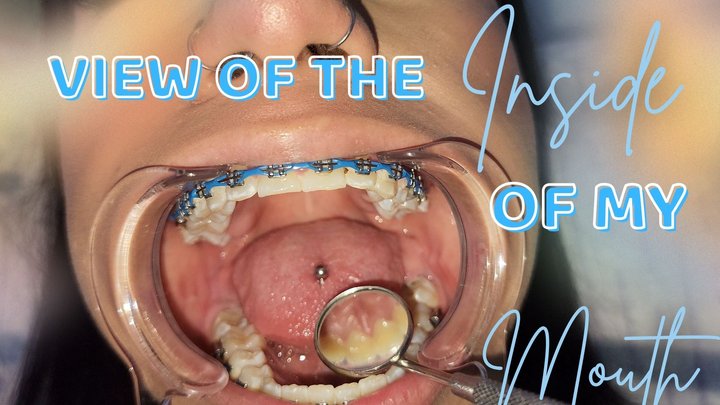 VIEW ON THE INSIDE OF MY MOUTH