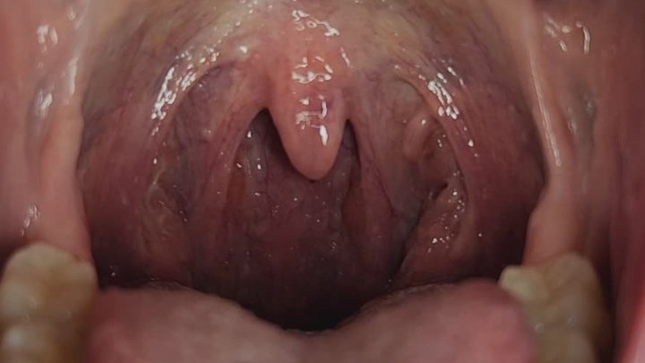 SASHAS UVULA